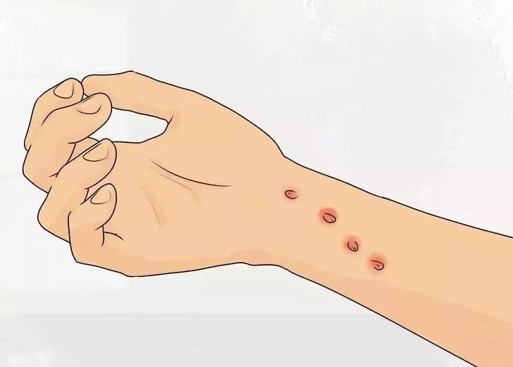 猫抓热是什么,猫抓后发热是什么原因