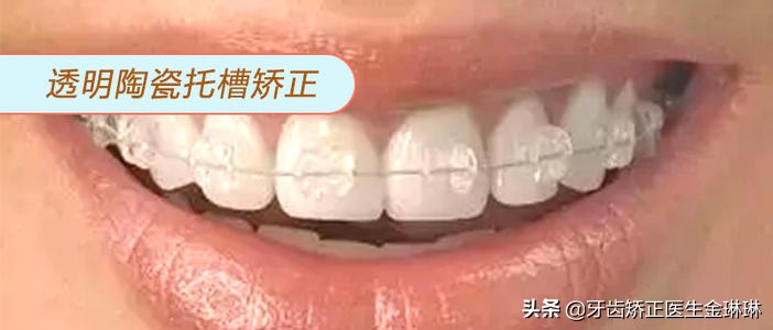 矫正牙齿不拔牙出现龅牙怎么办,40岁矫正牙齿拔牙不拔牙有区别吗