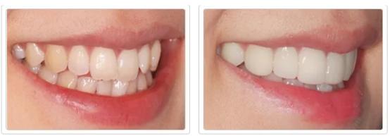 一口黄牙怎么办？10年牙科医生教你怎么拥有一口亮白美牙