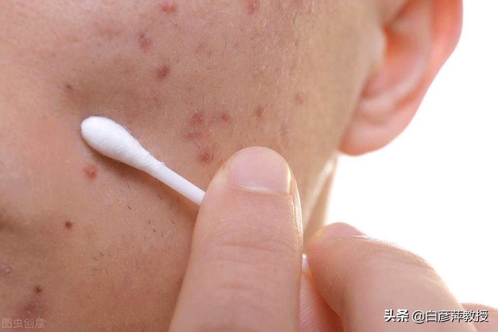 痤疮青春痘的真正内因是什么,总结8个青春痘的形成原因