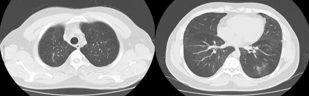 青年男性肺炎过后一直咳嗽怎么办,潜伏结核感染咳嗽咳痰