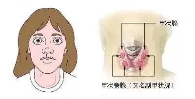甲状腺结节单个1.6厘米恶性概率,甲状腺结节单发90%是恶性