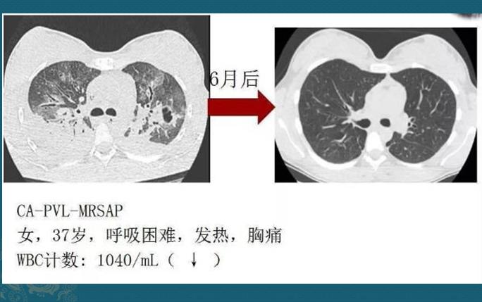 化脓性肺炎，硬扛3天不吃抗生素必后悔，这个细菌专治各种不服