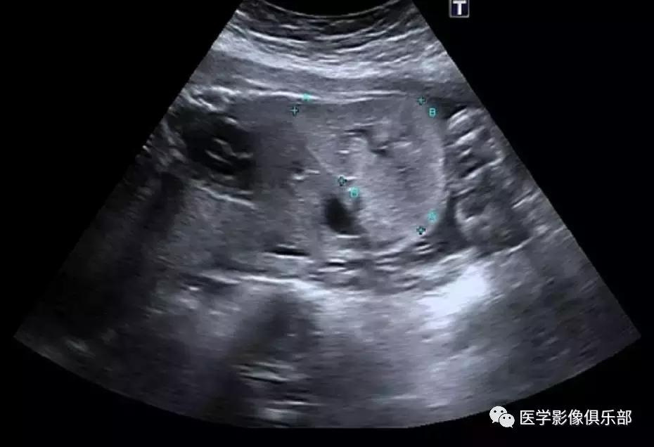 双肾多发小囊肿到底是不是多囊肾,肾多发囊肿与多囊肾的超声鉴别