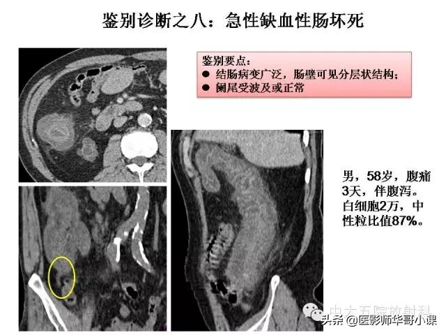 阑尾炎课件,阑尾炎的超声课件