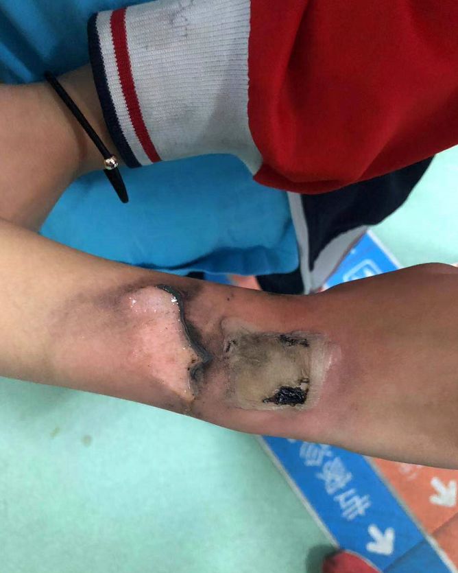 河口家长注意！孩子天天佩戴的这东西，出事了