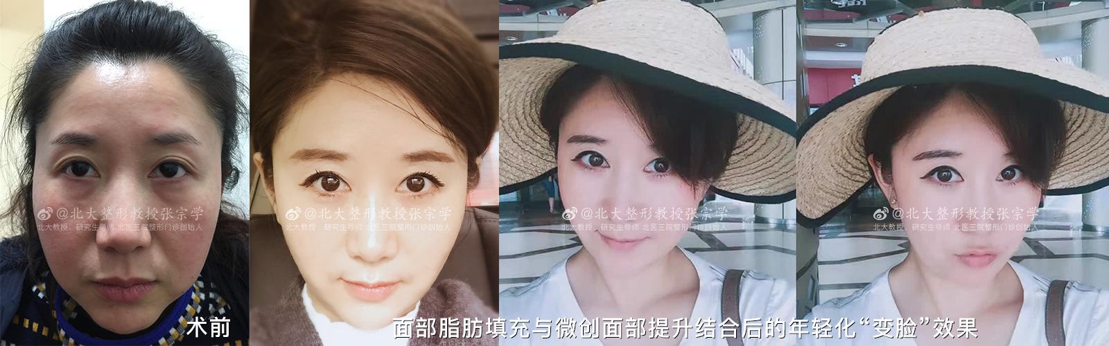 拉皮术除皱后会衰老更快吗,做拉皮手术后皮肤会衰老得更快吗