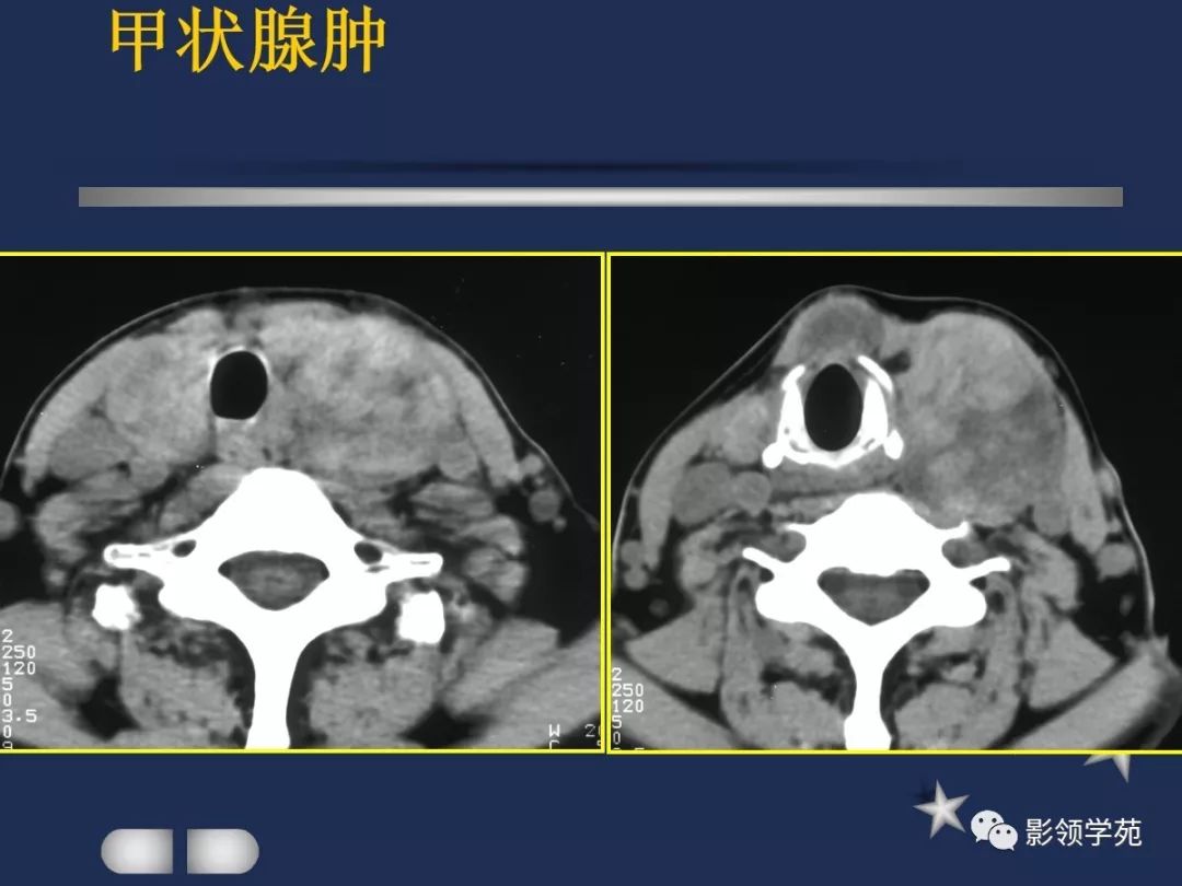 腮腺疾病影像学诊断,腮腺肿块影像诊断