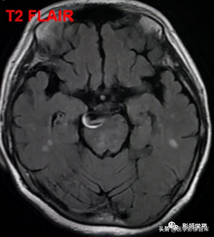 鞍区肿瘤做什么检查得出来,鞍区肿瘤的影像学鉴别