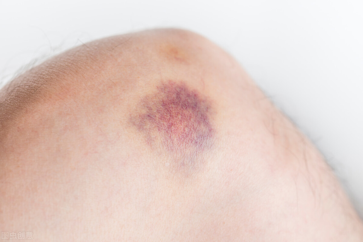 血瘀体质有什么表现11种症状自测,血瘀的五大表现