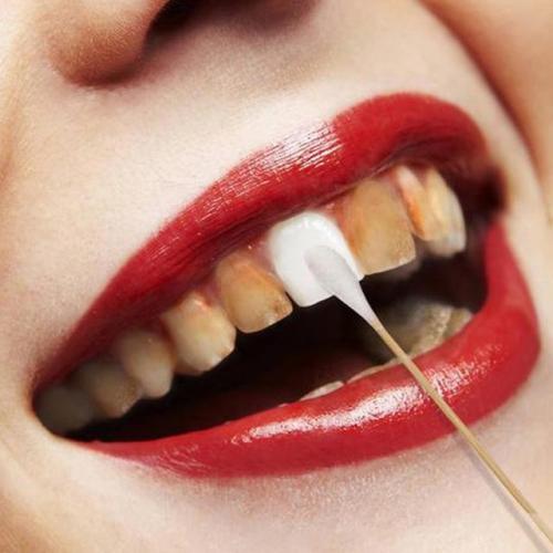 美白牙齿方法洗牙,除了洗牙怎么美白牙齿