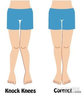 x型腿该怎么解决呢,x型腿怎么治
