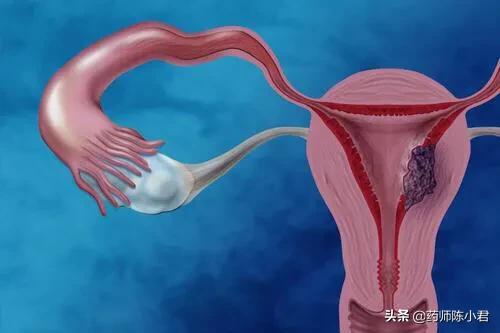 宫颈癌晚期大出血有危险吗,宫颈癌后期流血多长时间致命