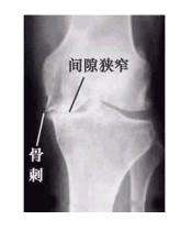 膝盖骨刺疼的最好治疗方法,膝盖骨刺疼痛怎么康复治疗