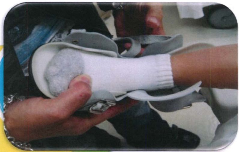 矫正鞋做法,马蹄足矫正鞋可调节