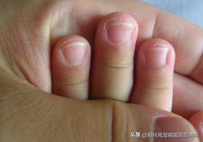 儿童类风湿的4个征兆,儿童得类风湿性关节炎严重吗