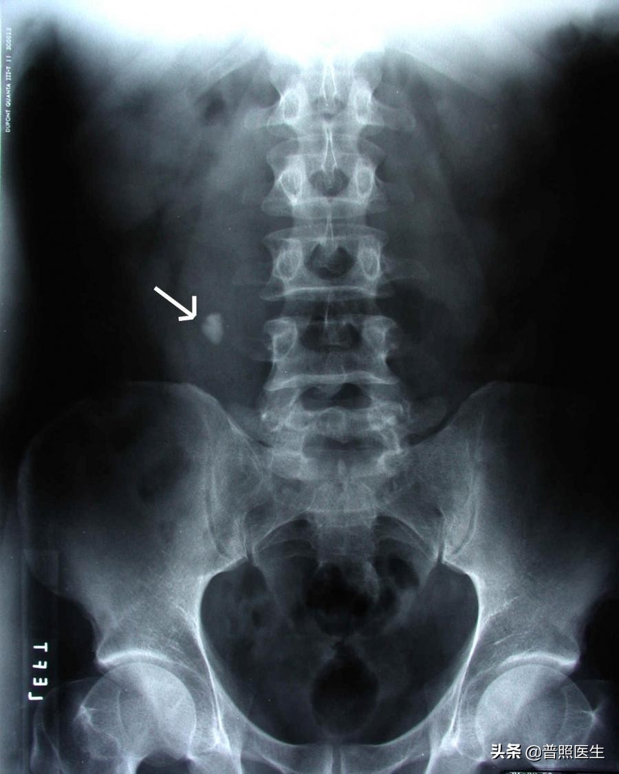 尿路小结石怎么治疗,为什么结石医生不建议做激光