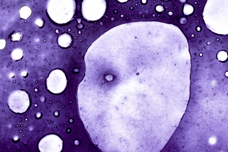 放射性粒子植入治疗癌症的过程,癌症放射性粒子植入对旁人的影响