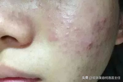 吃火锅长痘吃什么药好呢,长痘吃火锅吃什么好