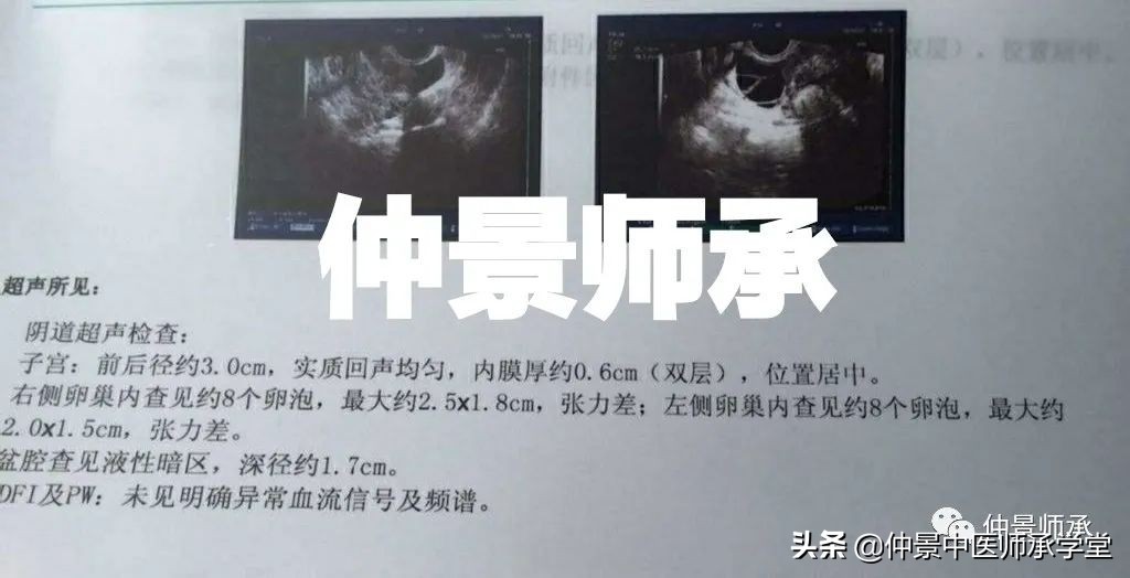 中医治多囊最好的方子,中医治疗多囊用西药吗