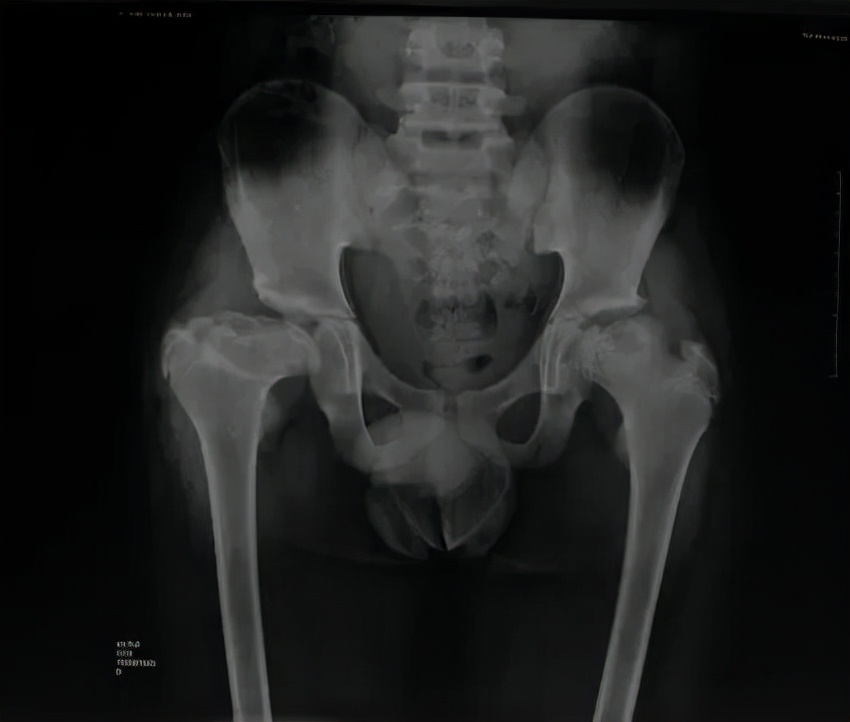 儿童医院儿童骨科,儿童骨科专家讲解