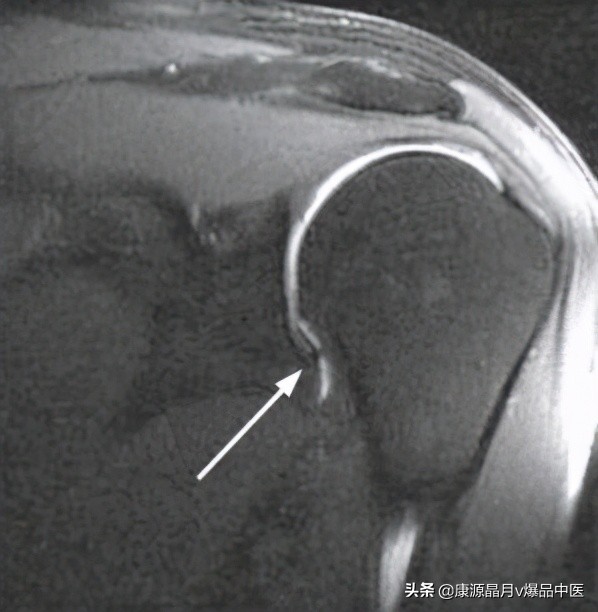 冻结肩一招解决,冻结肩怎么调