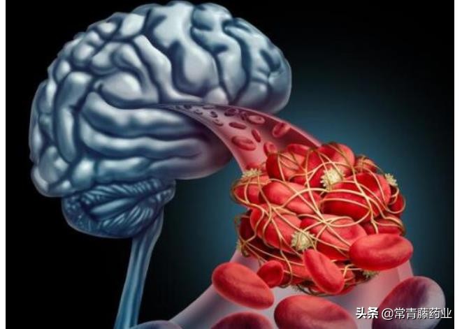 突发脑中风怎么急救,一旦患上中风会发生什么常见表现