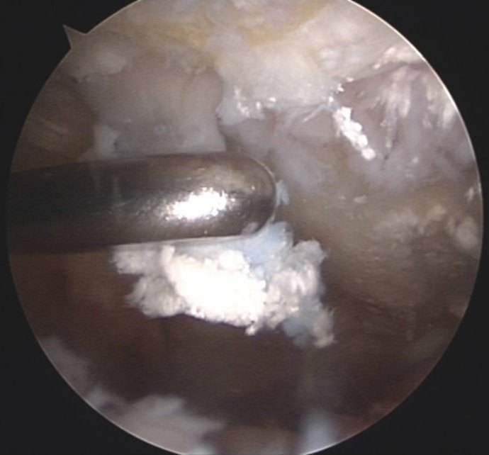 痛风膝关节红肿疼痛如何快速消除,膝关节痛风性关节炎mri表现