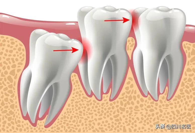 智齿一次拔几颗比较好,智齿到底要不要拔掉一个视频