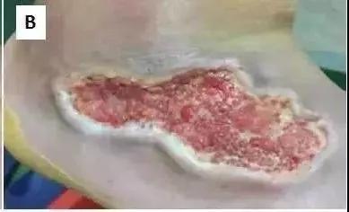 造血干细胞重获新生,神奇的干细胞让他们重获新生