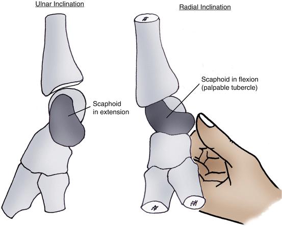 中医治疗腕舟骨骨折,经皮钢板治疗胫骨骨折