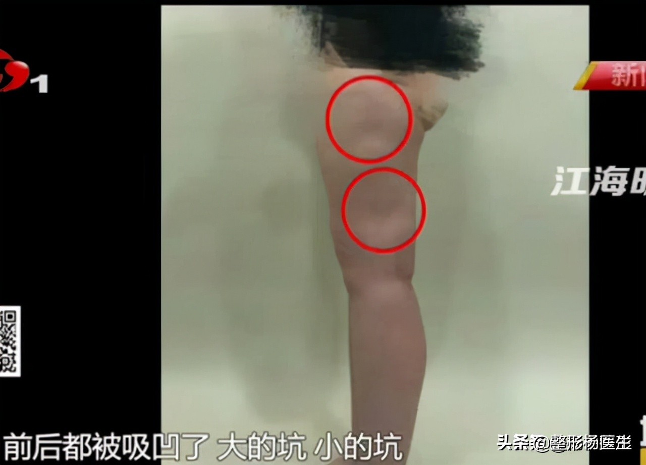 20岁面部凹陷如何改善,脂肪填充面部凹陷怎么导致的呢