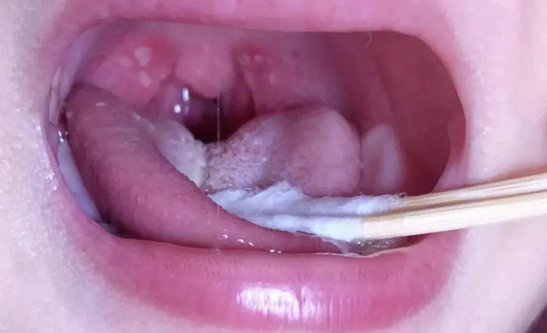 疱疹性咽峡炎高发期，家长怎么做才能防治？