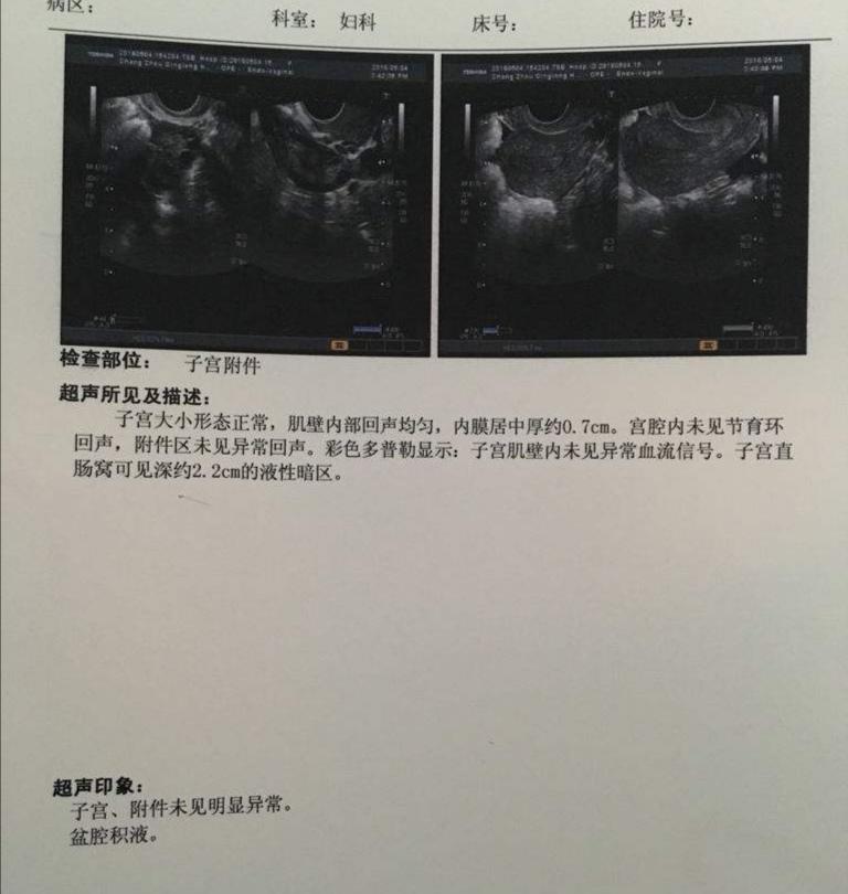 辟谣：B超检查发现盆腔积液，需要治疗？妇科医生：不要盲目处理