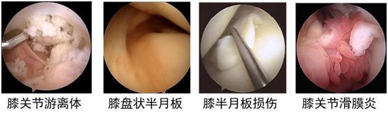 上下颌关节弹响怎么治疗,小孩蹲起时膝盖关节响是什么原因