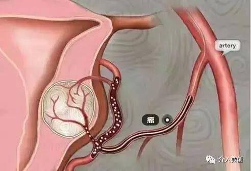 从手腕处做子宫动脉栓塞手术,子宫肌瘤做动脉穿刺有危险吗