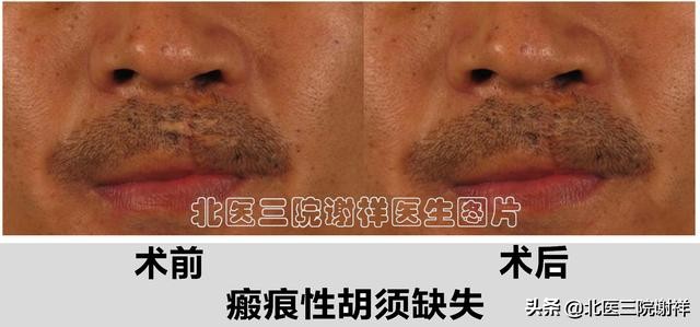 胡子种植可行吗需要注意哪些问题,胡子种植有什么讲究