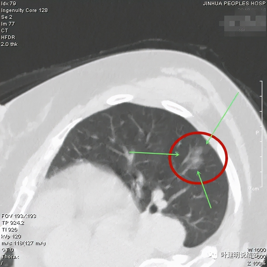 从活检怎么看是非小细胞癌,从病例谈辨证论治