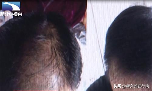 小伙购买生发剂,男人网购生发液头上却长满脓包