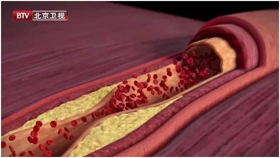 这5种炎症可能会演变成癌症,炎症发展成癌症的几率有多大