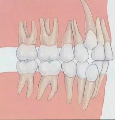 牙齿矫正之七大误区,牙齿矫正这14个副作用你信了几个