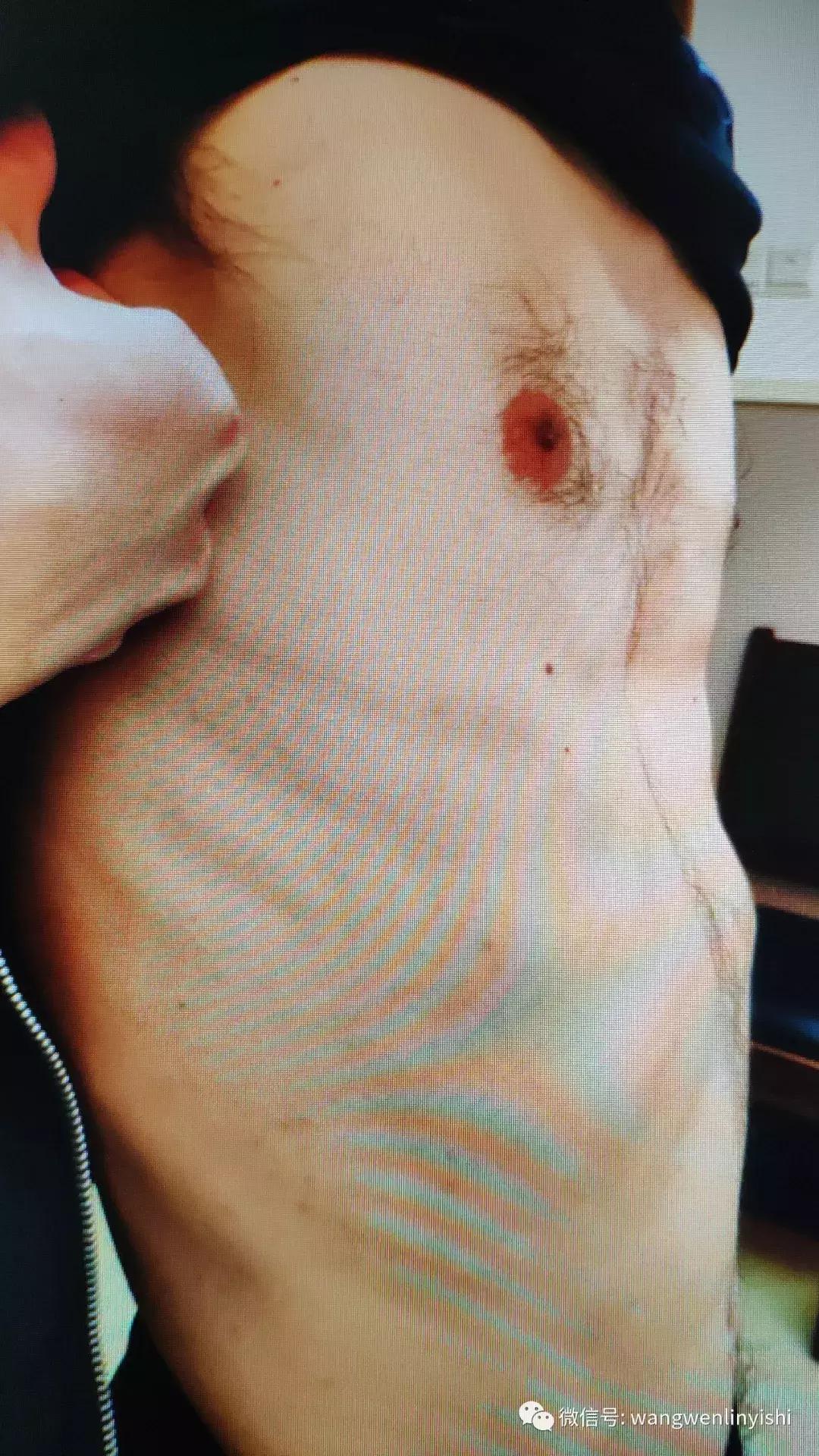 胸壁开放性手术恢复全过程,胸壁清创缝合术