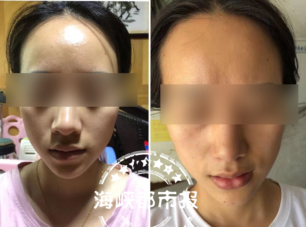 女子花6万元隆鼻被整歪,一女子整容花了50多万