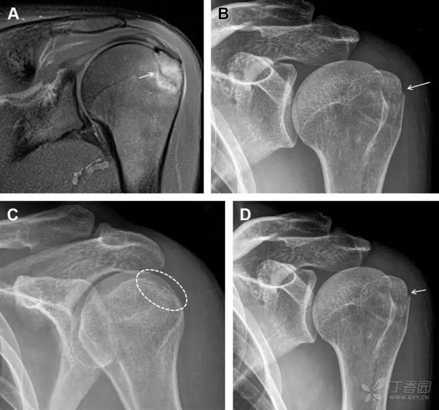 值夜班急救措施,放射科容易漏诊的骨折