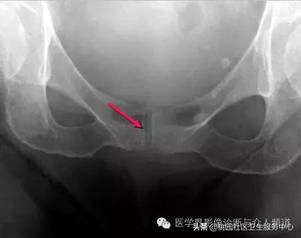 软组织钙化是不是骨化性肌炎,软组织钙化或骨化