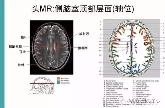 电子版头颅ct与mri断层解剖,头颅mri血管解剖与分段详解