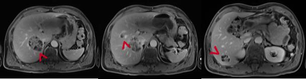 精准放疗高效解决鼻咽癌免疫治疗后寡进展病例分享