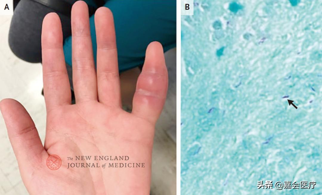 妻子左手小指头肿胀,竟是丈夫外出旅行导致的?