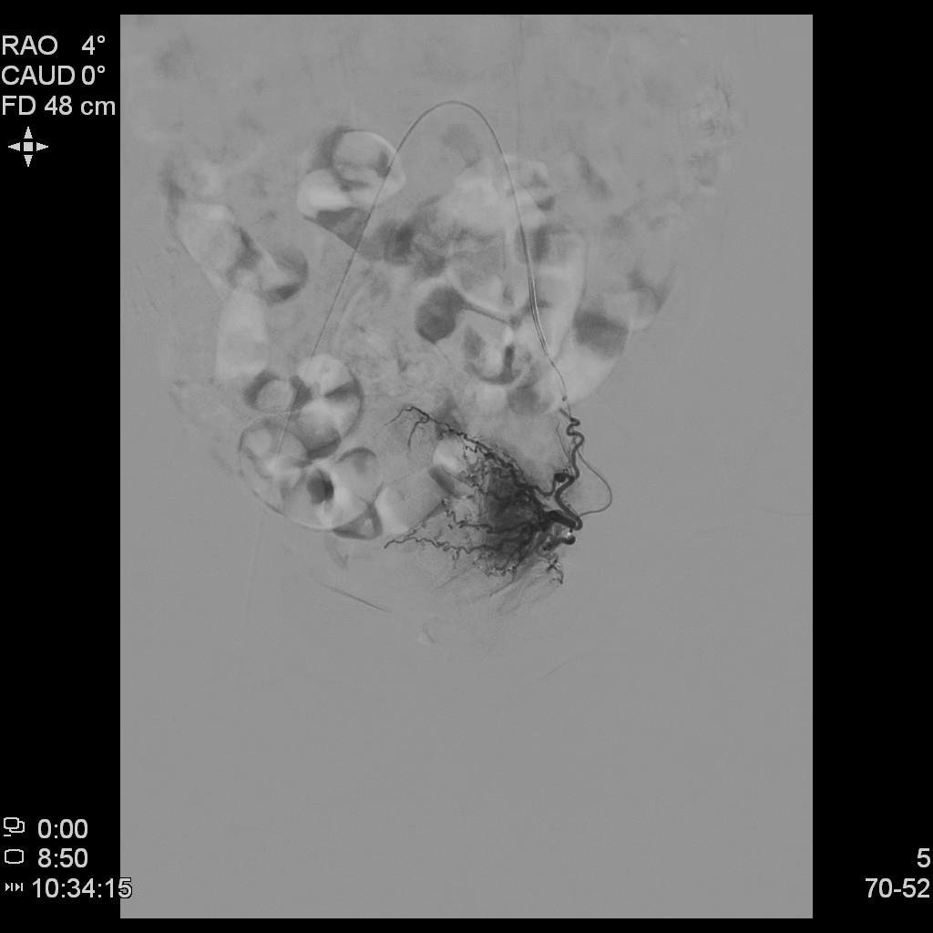 子宫腺肌症称为不死的癌症,子宫腺肌症是不死的癌症吗