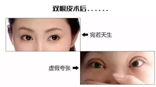 想做双眼皮是不是得检查下视力,想做双眼皮攻略